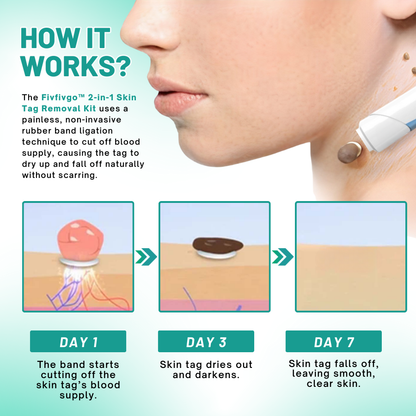 Melax™ 2-in1 Skin Tag Removal Kit